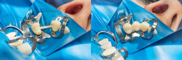 filling and restoration of tooth loss with adhesive composite material close-up. Concept before and after dentistry treatment