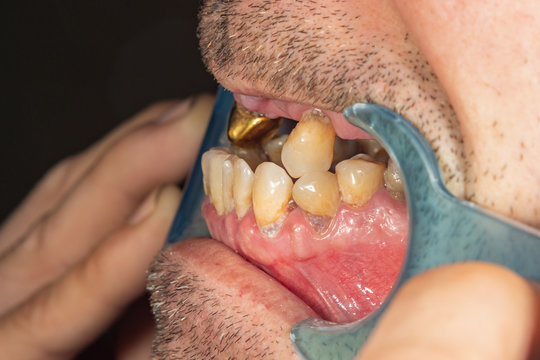 Patient's Bad Teeth At The Dentist's Dentist Close-up Macro. Caries, Plaque Harm Smoking