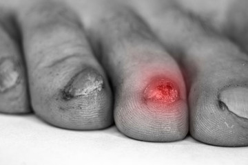 Obraz premium Fungus Infection on Nails of male Feet