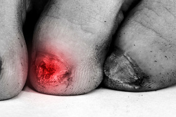 Fungus Infection on Nails of male Feet