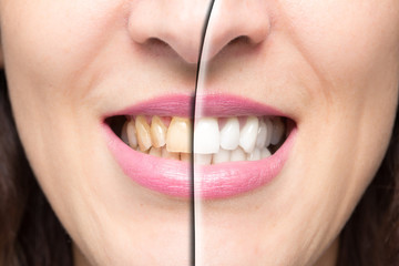 Woman teeth close up before and after whitening treatment