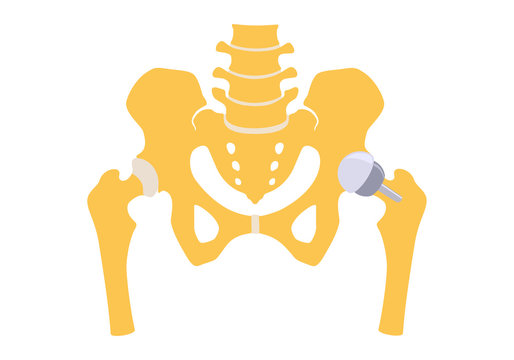 Hip replacement partly half. Vector illustration. Isolated on white background