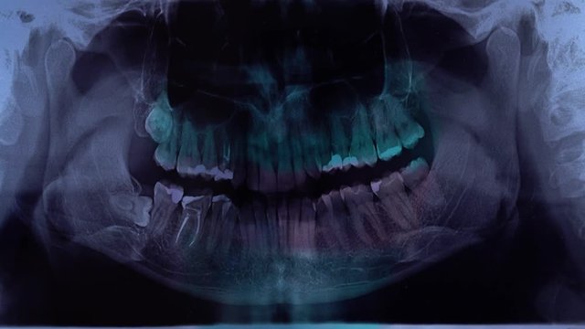 Closeup of dentist looking at dental x-ray plate examines the dental arch. X-ray image while using computer