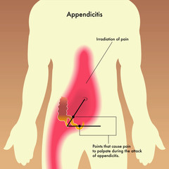 medical illustration showing the points that cause pain to palpate during the attack of appendicitis.