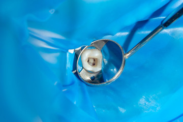 two chewing side teeth of the upper jaw after treatment of caries. Restoration of the chewing surface with a photopolymer filling material using the Rubber Dam system © Сергей Кучугурный