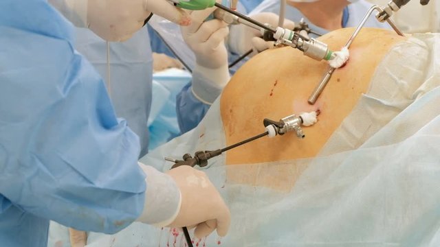 Laparoscopy. The hands of doctors using endoinstruments and video cameras perform surgery in the abdominal cavity of a fat man or a pregnant woman. Modern advances in medicine. Endoscopy