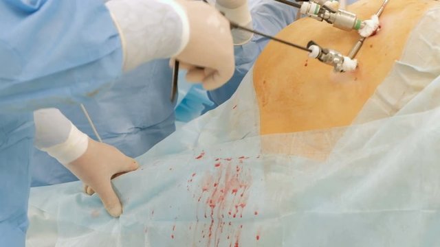 Endoscopy. Laparoscopy. The hands of doctors using laparoscopic instruments perform surgery in the abdominal cavity of a fat man or a pregnant woman. Camera movement from left to right. Modern