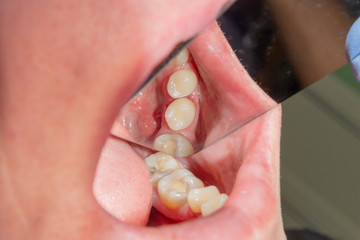Dental caries. Filling with dental composite photopolymer material using rabbders. The concept of...