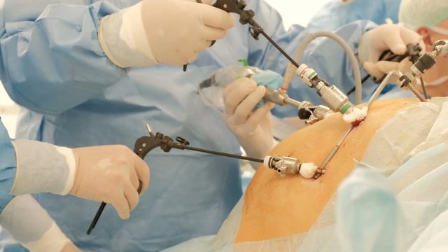 Endoscopy. Close-up. Surgeons' hands with the help of endoscopic equipment and instruments perform surgery of a fat man or a pregnant woman. A team of doctors at work. Laparoscopy. Endovideosurgery.