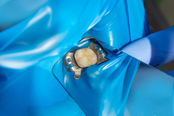 Dental caries. Filling with dental composite photopolymer material using rabbders. The concept of...