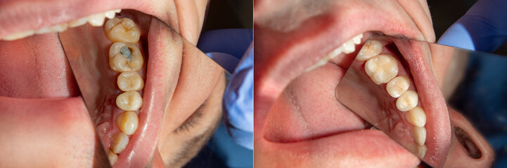 Obraz premium two chewing side teeth of the upper jaw after treatment of caries. Restoration of the chewing surface with a photopolymer filling material using the Rubber Dam system