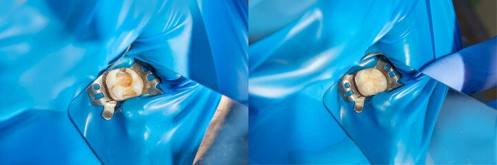 two chewing side teeth of the upper jaw after treatment of caries. Restoration of the chewing surface with a photopolymer filling material using the Rubber Dam system © Сергей Кучугурный