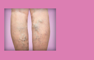The varicose veins on a legs of old woman