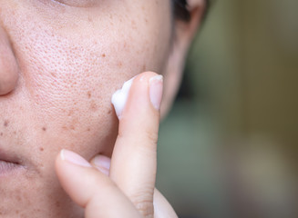 Woman applying cream onto face that has problem problematic skin , acne scars ,oily skin and pore,...