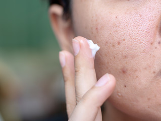 Woman applying cream onto face that has problem problematic skin , acne scars ,oily skin and pore, dark spots and blackhead and whitehead on the face.