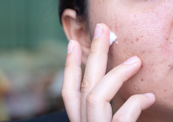 Woman applying cream onto face that has problem problematic skin , acne scars ,oily skin and pore,...