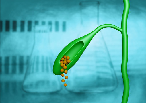 Gallbladder, Isolated With Cut Showing Formation Of Stones That Cause Obstruction, Pain And Inflammation