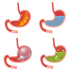 Fototapeta premium Vector Realistic Stomach medical vector illustration set. Pyrosis fire disorder, gastric acid reflux, Abdominal bloated ball, green liquid nausea.