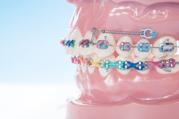 orthodontic model and dentist tool - demonstration teeth model of varities of orthodontic bracket or brace