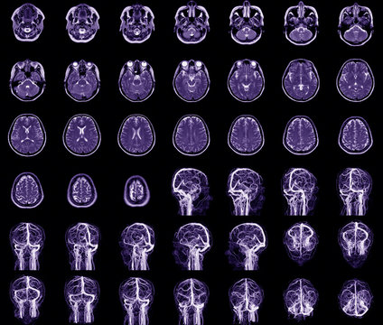 MRI brain, x-ray film of the brain, computed tomography.