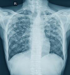 Pulmonary Tuberculosis ( TB ) : Chest x-ray .
