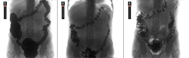 X-ray of the lower parts of the gastrointestinal tract (GI). Tight filling. Emptying. Insufflation by air. Diverticulosis. Negative.