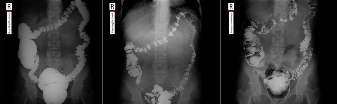 X-ray of the lower parts of the gastrointestinal tract (GI). Tight filling. Emptying. Insufflation by air. Diverticulosis. 