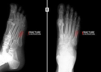 X-ray of the foot. Fracture of the 5th metatarsal bone. Marker.