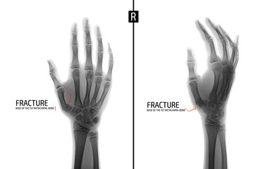 X-ray of the hand. Fracture of the base of the 1st metacarpal bone. Marker. Negative.