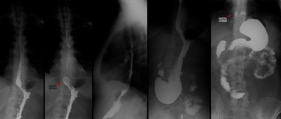 X-ray of the upper gastrointestinal tract (UGI) with barium. Hiatal hernia. Marker.