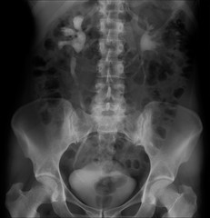 X-ray of the abdomen. Hydronephrosis right. Pyeloectasia left. 