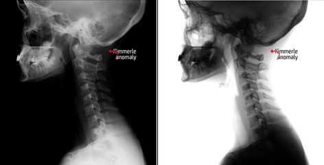 X-ray of the cervical spine. Kimerly anomaly. Marker.