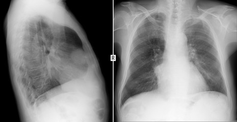 X-ray of the lungs. Volume formation of the mediastinum. Teratoma. 