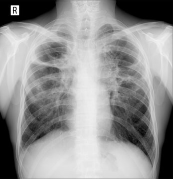 X-ray of the lungs. Pulmonary fibrosis. Post tuberculosis. 