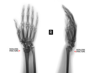 X-ray of the wrist joint. Fracture of the radius. Negative. Marker.