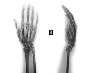 X-ray of the wrist joint. Fracture of the radius. Negative.