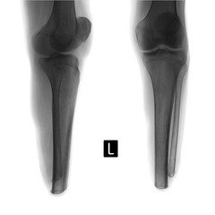 X-ray of the shin. Stump of the left shin. Negative. 