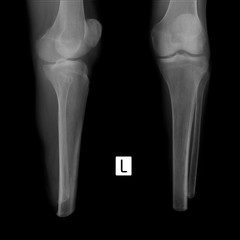 X-ray of the shin. Stump of the left shin. 