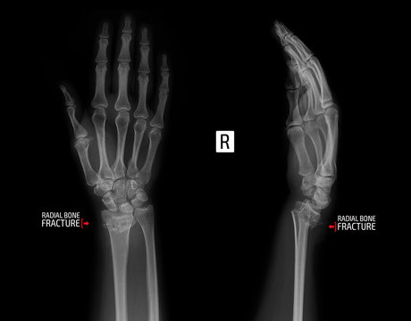 X-ray of the wrist joint. Fracture of the radius. Marker.