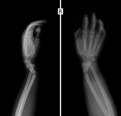 X-ray of the wrist. Greenstick fracture of the radius. 