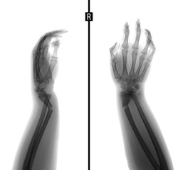 X-ray of the wrist. Greenstick fracture of the radius. Negative.