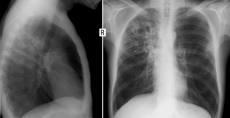 X-ray of the lungs: Tuberculosis of the lungs. 