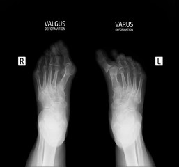 X-ray of the foot. Varus and valgus deformity of the 1st finger. 