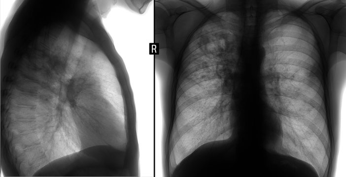 X-ray of the lungs: Tuberculosis of the lungs. Negative.