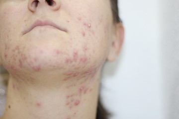 Allergy concept,young girl with problematic pimple on the face.-image.