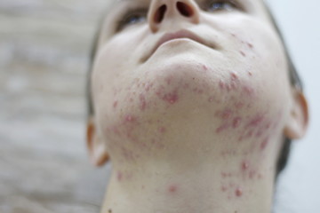 Allergy concept,young girl with problematic pimple on the face.-image.