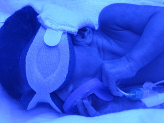 Premature baby with blue bilirubin lights