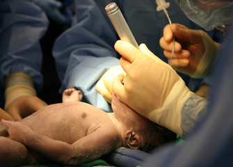 Newborn intubation in delivery room