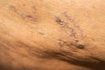 Varicose veins on a leg in Senior women, Close up & Macro shot, Selective focus, Asian body skin part, Healthcare concept