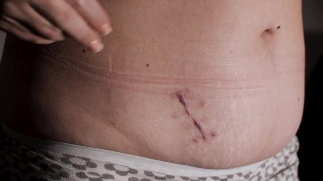 Woman showing the stomach with a appendicitis scar after abdominal surgery. Scar removal